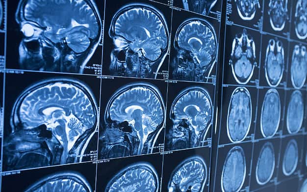 Brain injury linked to intestinal damage