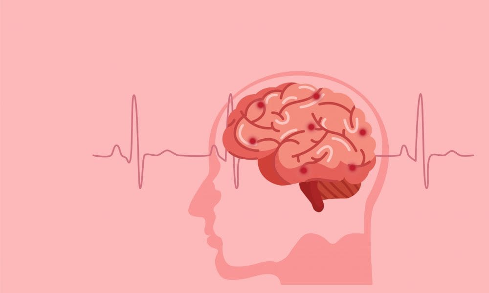 Stroke risk after TBI ‘can last five years’