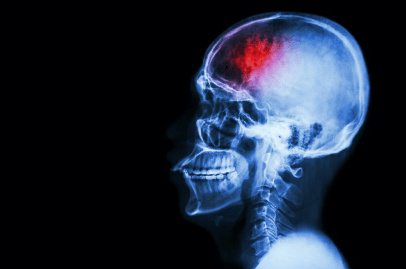 Robotic exoskeleton supports adolescents with acquired brain injury