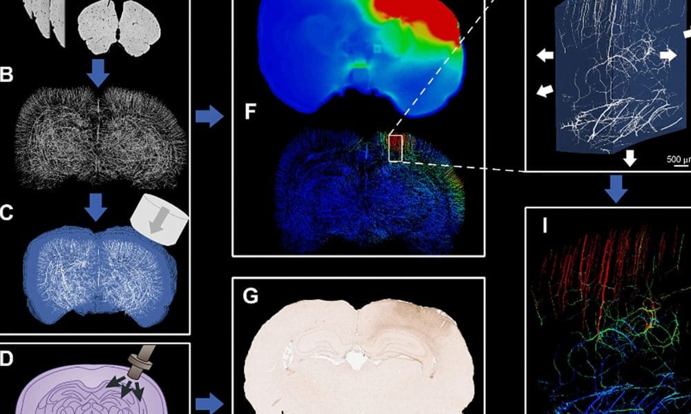 High-res computer modelling to shed new light on TBI impact