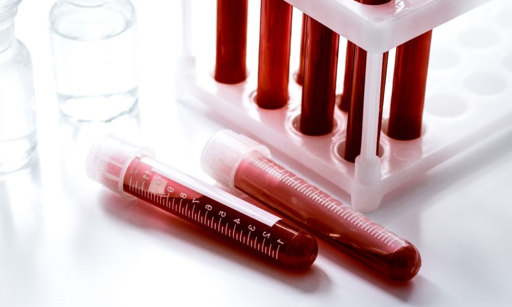 glass tubes with blood sample in stand no one Blood study bids to find early Alzheimer’s test