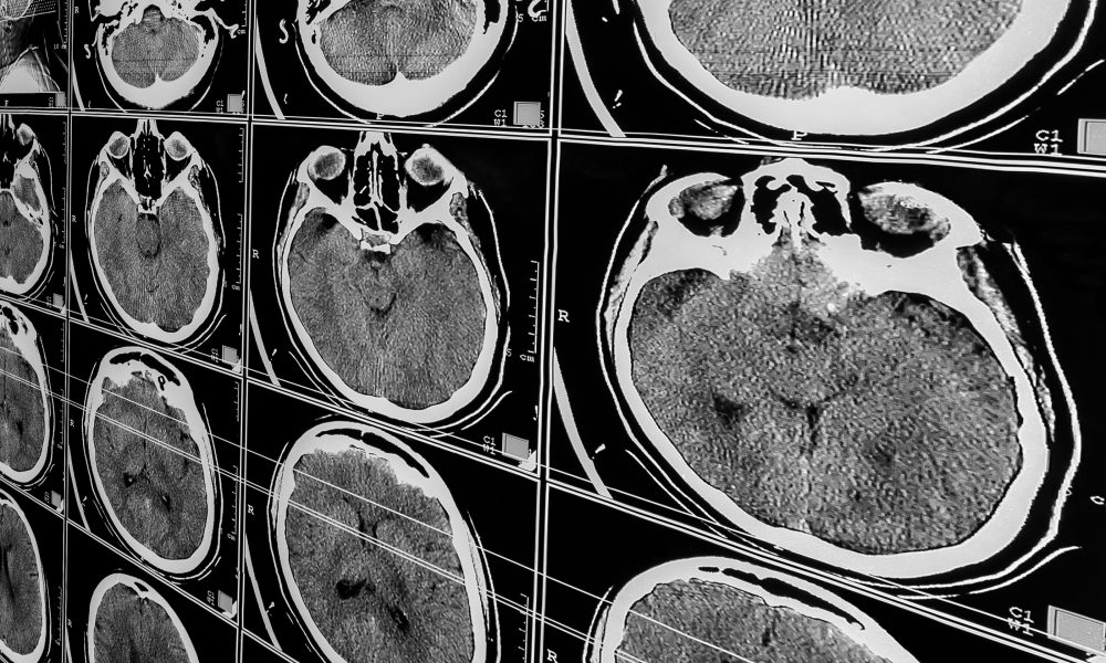 Further links between brain trauma and dementia in new study
