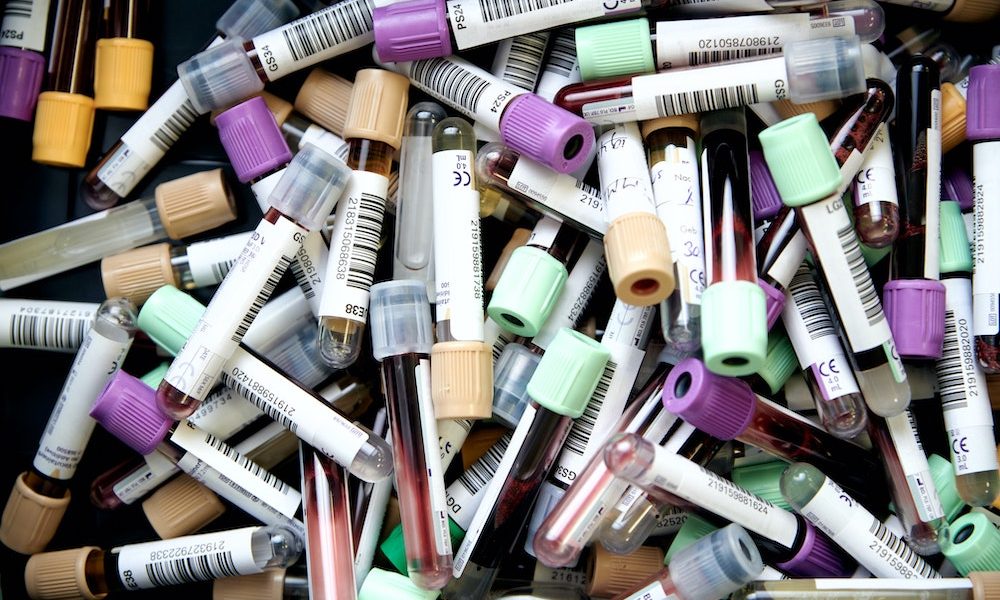 Newly brain injured patients’ blood test predicts death