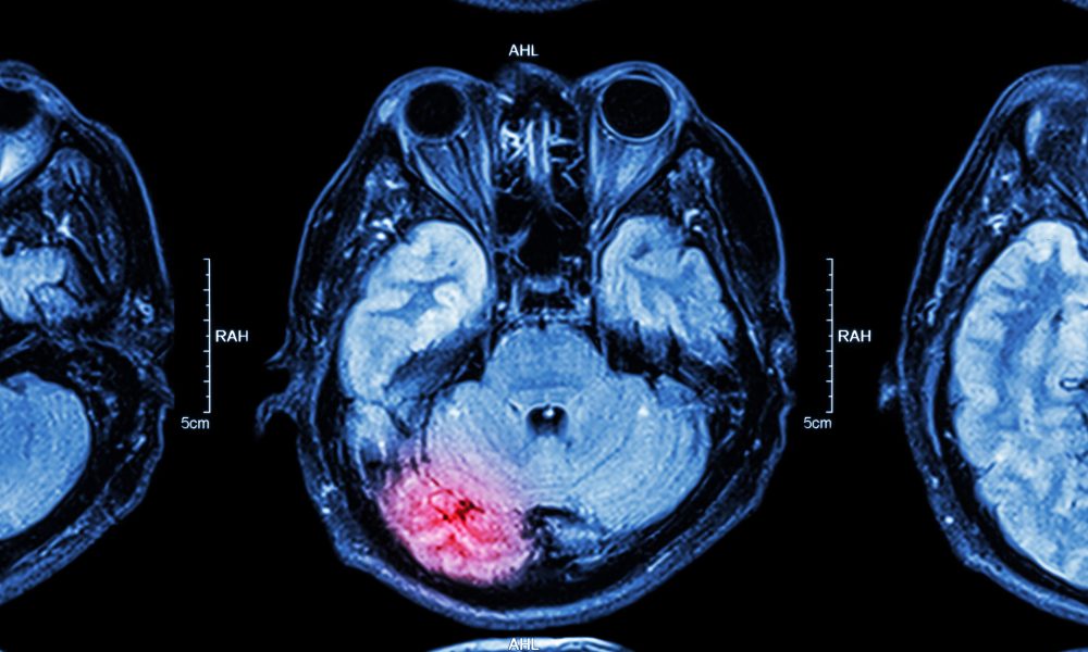 Thrombectomy reduces disability and mortality in large strokes, study finds