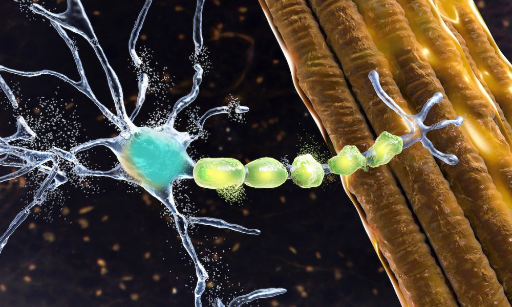 UK MND Research Institute advances towards new treatments