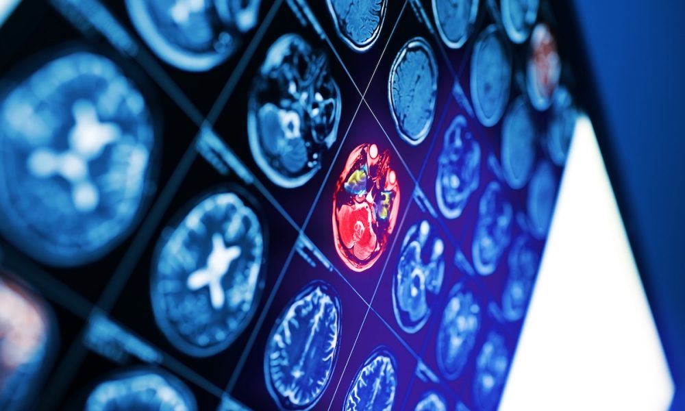 High prevalence of brain changes in people with heart disease – study