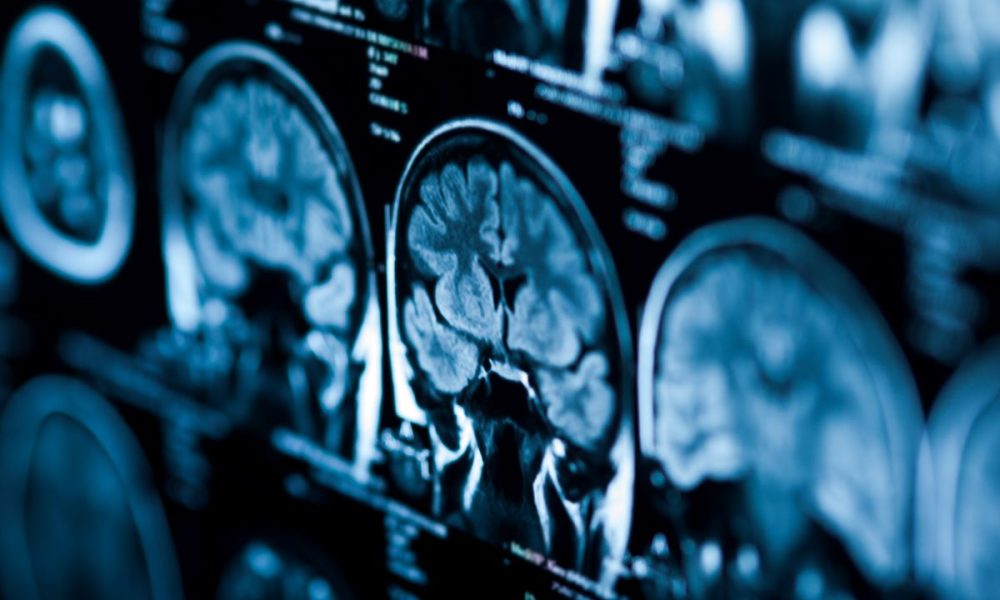 AdobeStock_220350807 Havana Syndrome: no evidence of MRI-detectable brain injury or biological abnormalities