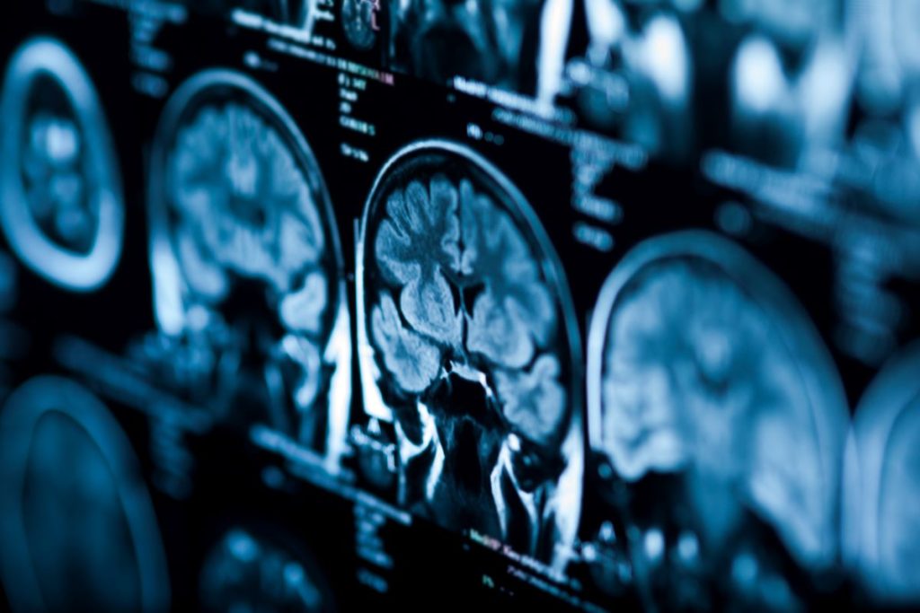 Havana Syndrome: no evidence of MRI-detectable brain injury or biological abnormalities