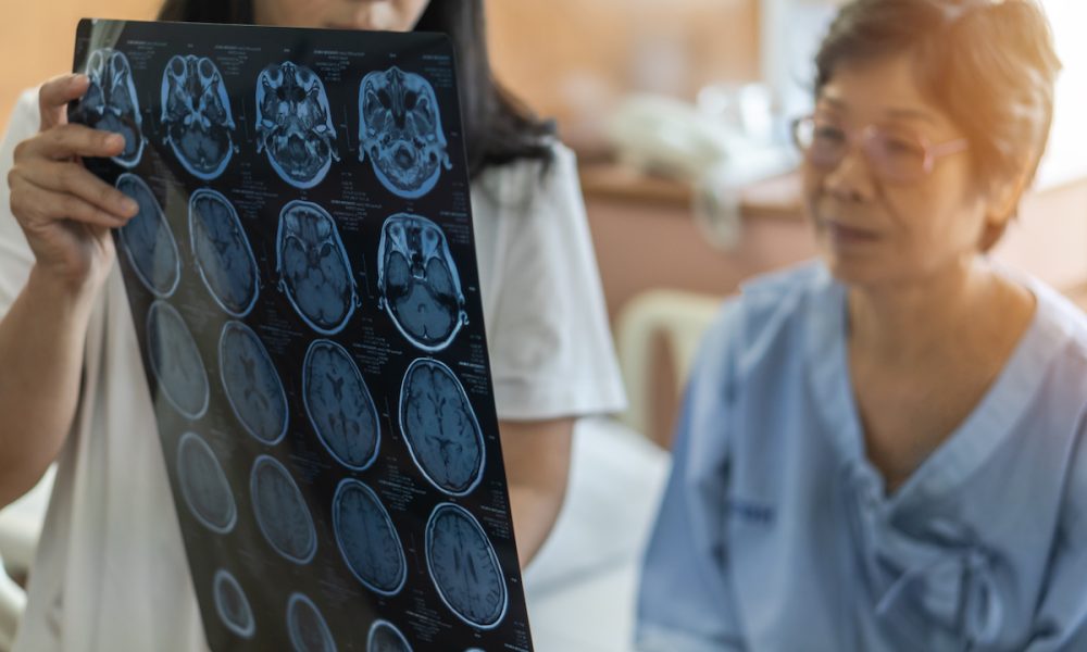 Brain disease diagnosis with medical doctor diagnosing elderly ageing patient neurodegenerative illness problem seeing Magnetic Resonance Imaging (MRI) film for neurological medical treatment Study finds intracerebral hemorrhage stroke outcomes improve with early minimally invasive surgery