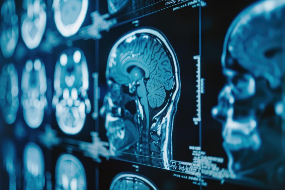 Huntington’s disease treatment slows progression by 75%, study finds
