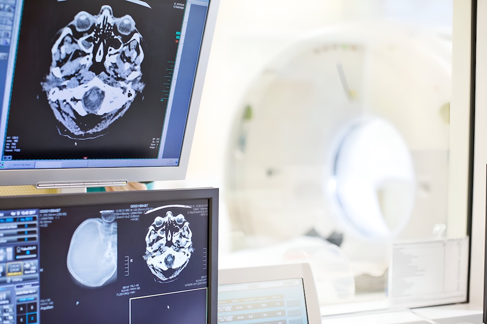 Stroke may ‘rejuvenate’ parts of the brain to aid recovery