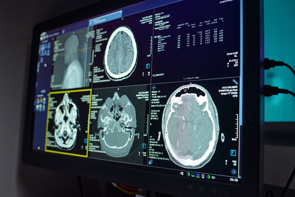 Life-saving stroke therapy still not available 24/7 across England
