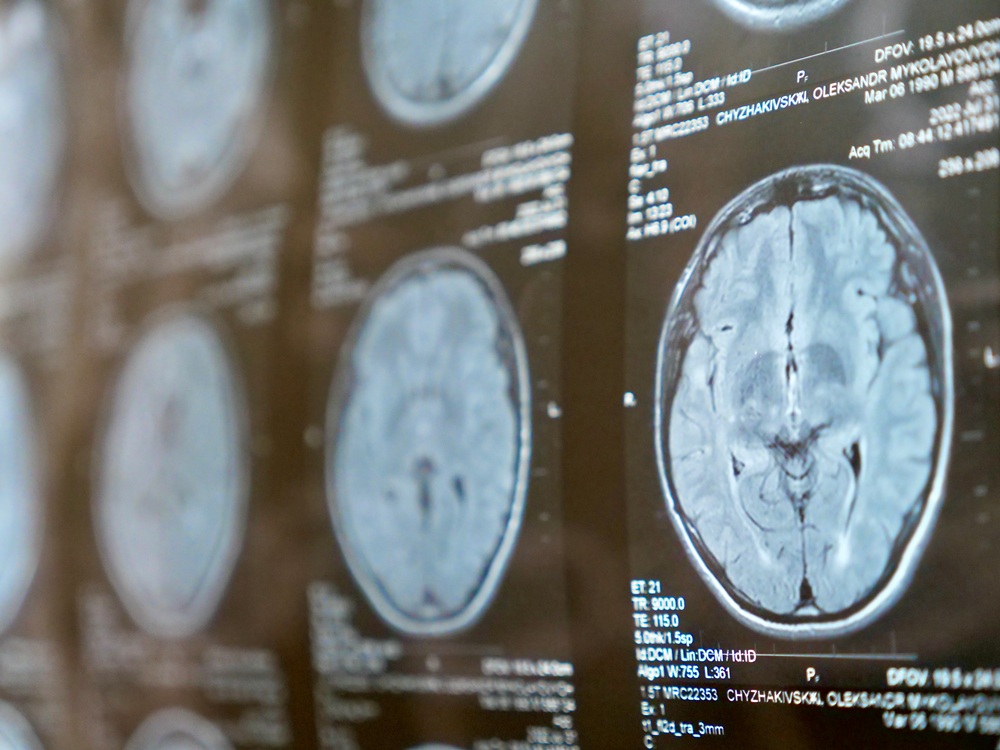 Severe strokes liked to five times higher dementia risk, study finds