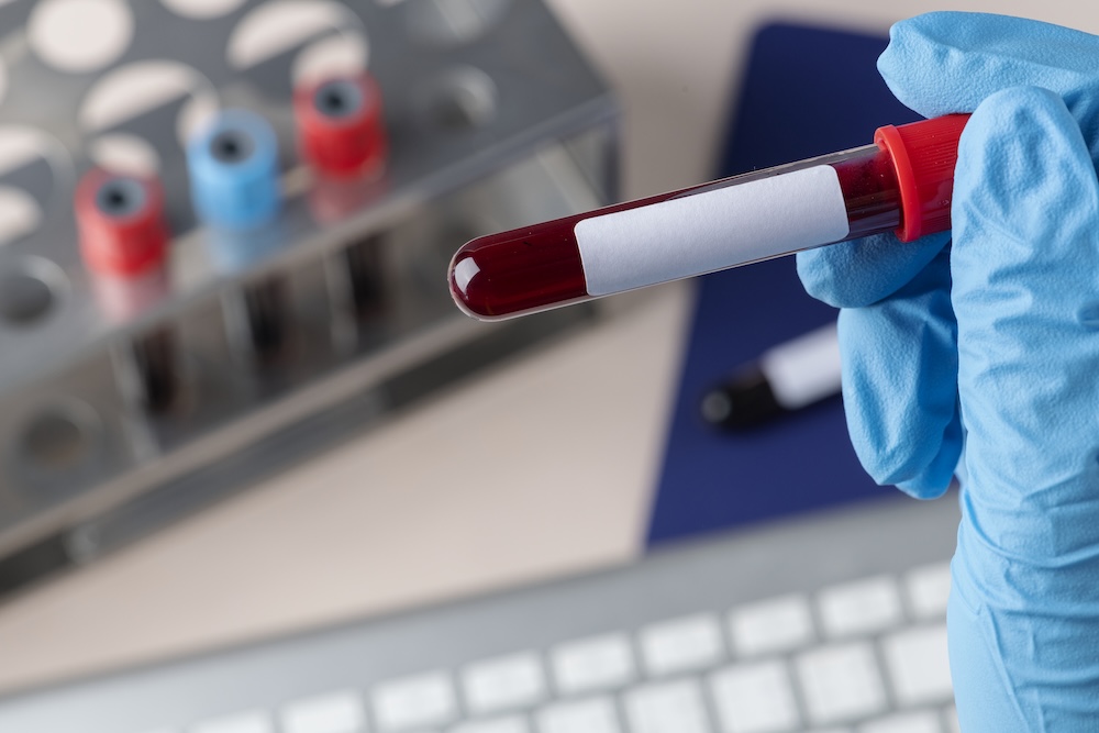 TBI blood test can speed up diagnosis, doctors say