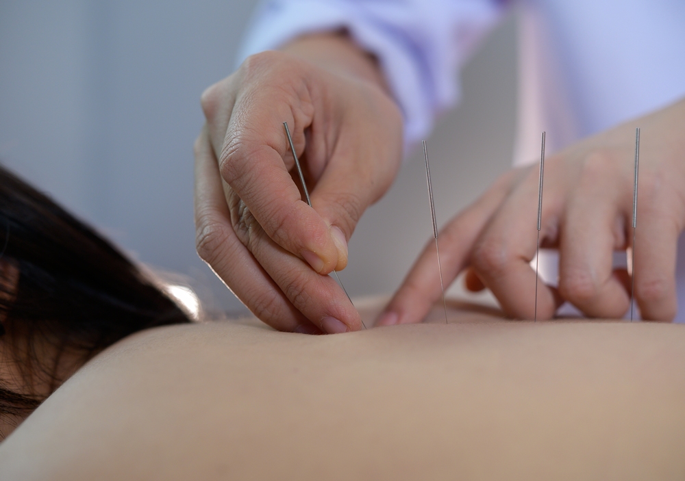 Acupuncture improves stroke recovery, study finds
