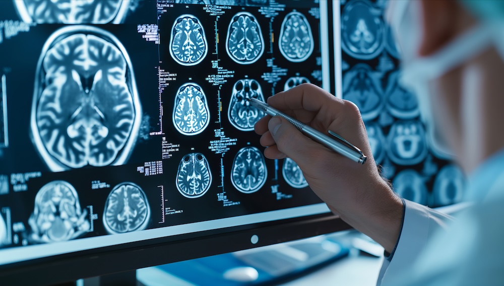 First patient receives neural stem cell therapy in groundbreaking Huntington’s trial