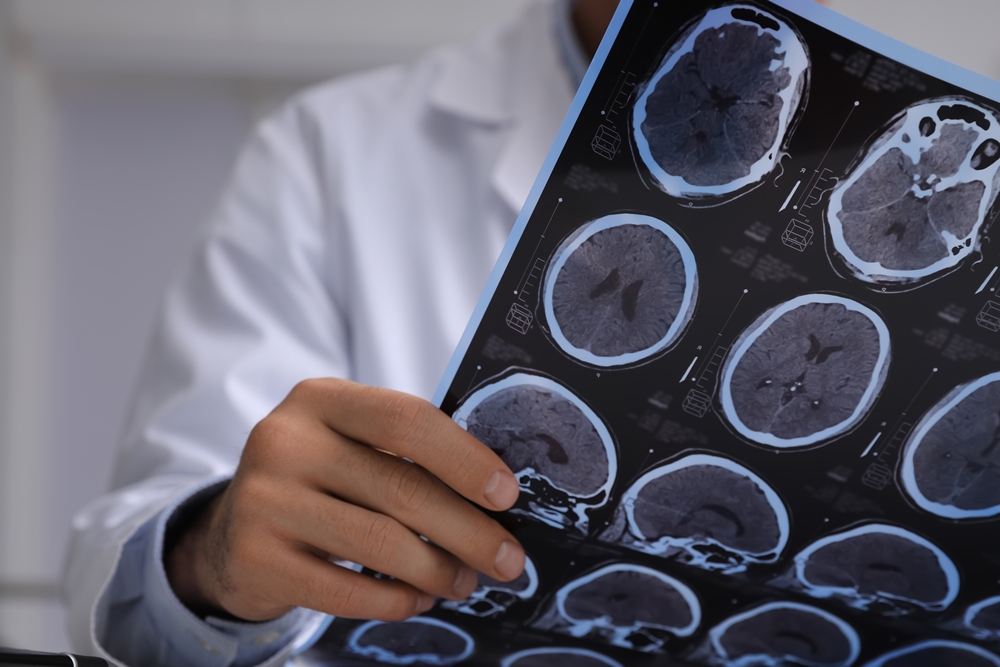 Brain legion breakthrough could transform MS