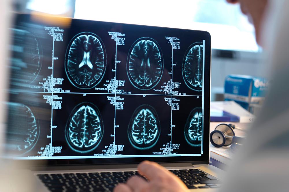 Research reveals hidden cause of common stroke