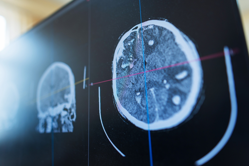 Automated MRI improves stroke research