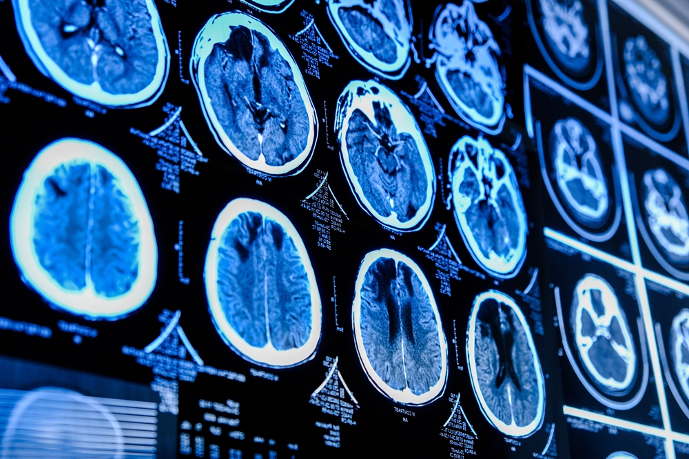 closeup-ct-scan-with-brain-medicine-science-education-mri-brain-background-magnetic-resonance-imaging-tomography-shot Brain research using light wins Nobel Prize in Medicine