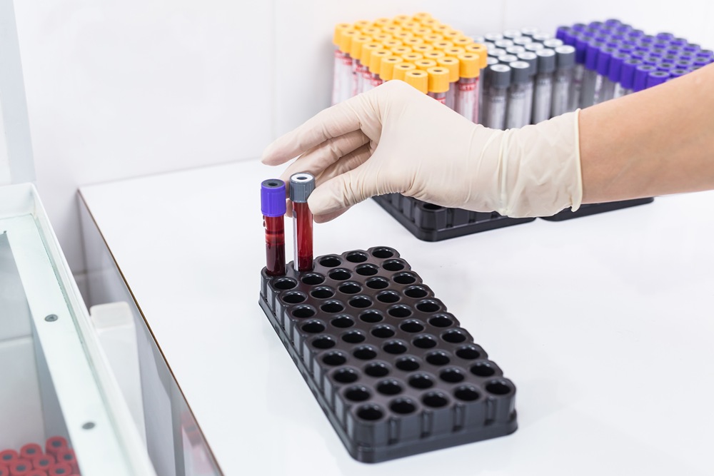Covid-19, pandemic and viruses concept – hand holding blood in tests tubes Dopamine discovery offers hope for new Parkinson’s treatments