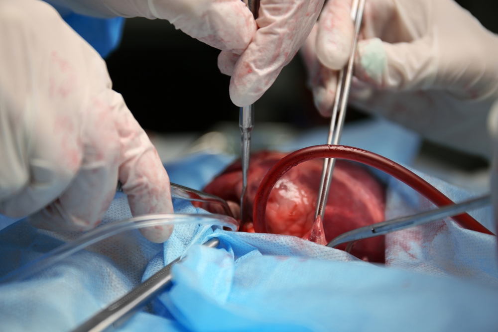 Stroke patients experience long-term benefits after thrombectomy – study