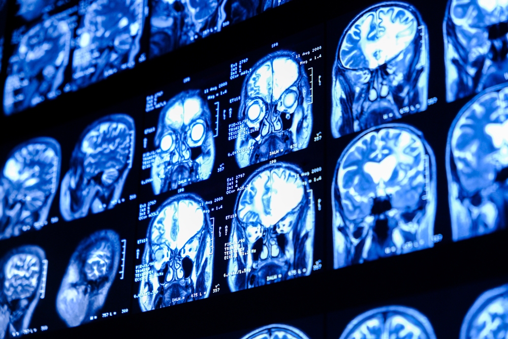 mri-scan-brain-diagnosis-medical-examination-health-prevention-tomography-shot-close-up-ct-scan-with-brain Delayed diagnosis of brain cancer: Medico-legal considerations
