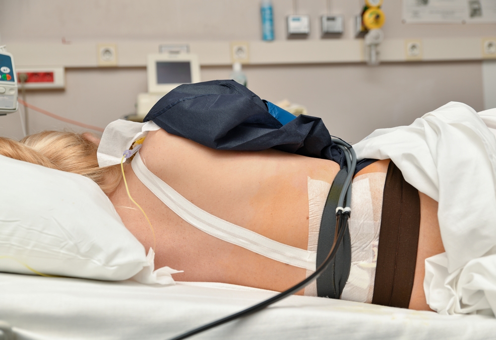 The woman lies in the birthplace with contractions and epidural anesthesia Trial tests spinal stimulation for low blood pressure after spinal injury